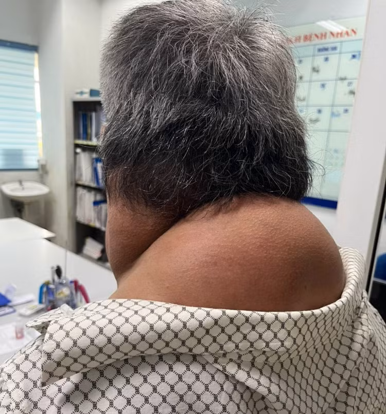Khối mỡ ở vùng cổ và sau gáy của bệnh nhân trước khi được phẫu thuật loại bỏ. Ảnh: BVCC.