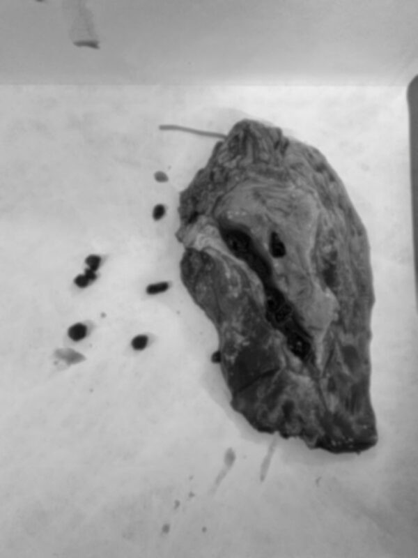 Một phần gan của bệnh nhân được cắt bỏ. Ảnh: BVCC