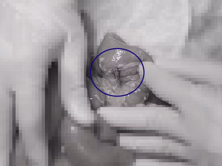 Dị vật trong ruột bệnh nhi. Ảnh BVCC