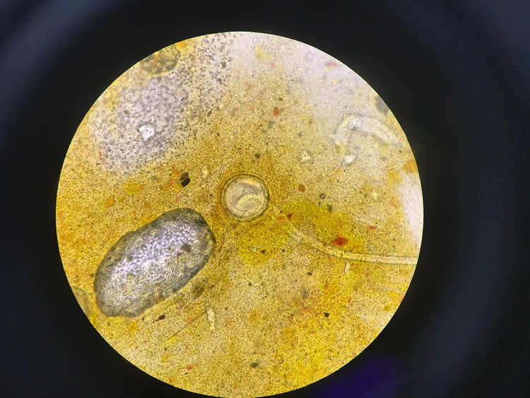 Trứng sán dây chuột trong mẫu phẩm của bệnh nhân khi soi qua kính hiển vi