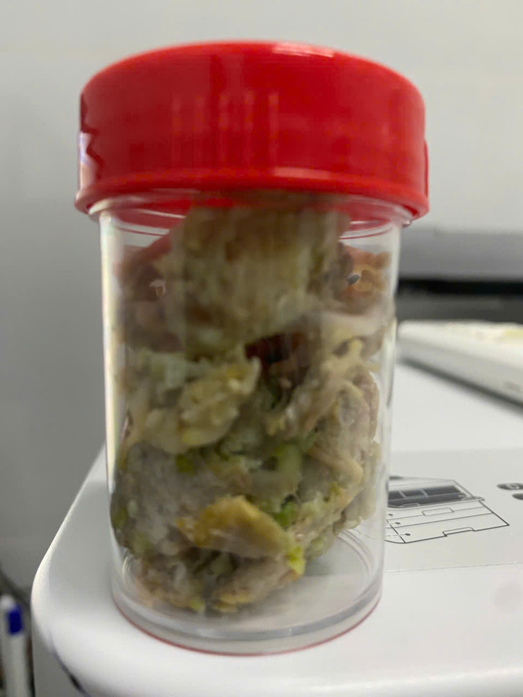 Khối gân bò kẹt trong thực quản của bệnh nhân. Ảnh BVCC Khối gân bò kẹt trong thực quản của bệnh nhân. Ảnh BVCC