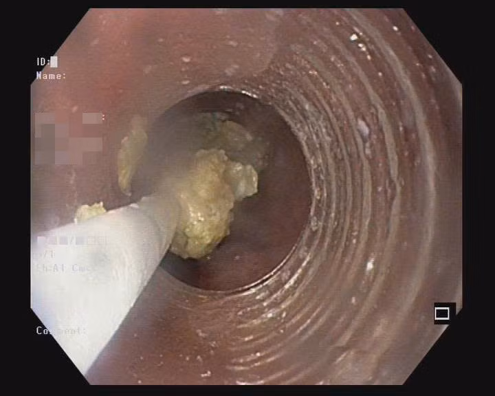 Khối gân bò kẹt trong thực quản của bệnh nhân. Ảnh BVCC Khối gân bò kẹt trong thực quản của bệnh nhân. Ảnh BVCC