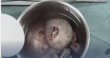 Ca phẫu thuật thành công lấy sỏi bàng quang to như quả trứng gà trên nền bệnh sỏi thận hai bên và sỏi niệu quản trái. Ảnh BVCC