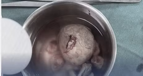 Ca phẫu thuật thành công lấy sỏi bàng quang to như quả trứng gà trên nền bệnh sỏi thận hai bên và sỏi niệu quản trái. Ảnh BVCC