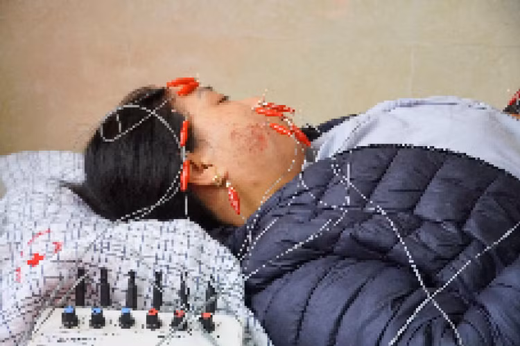 Bệnh nhân bị liệt mặt do tự ý điều trị bệnh tại nhà. Ảnh Trung Y tế huyện Cẩm Khê (Phú Thọ)