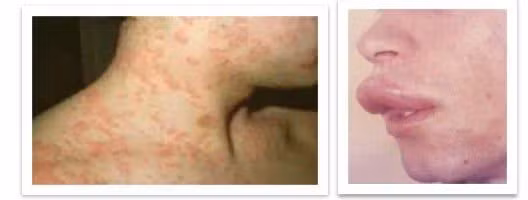 Biểu hiện da niêm hay gặp ở phản vệ: nổi mề đay và phù nề niêm mạc. Ảnh minh họa