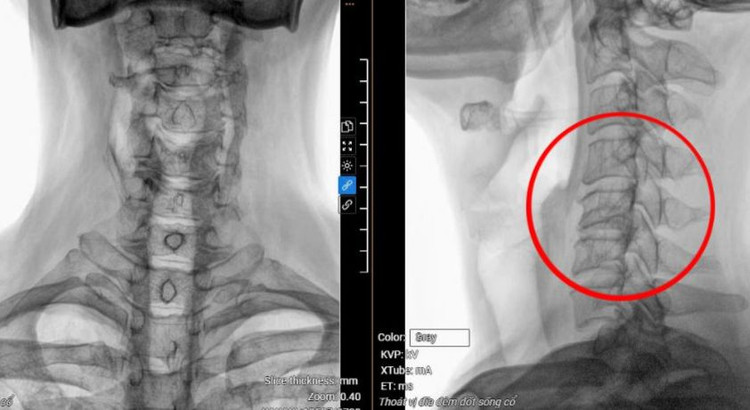 Phim chụp MRI hiển thị vị trí đốt sống cổ bị thoát vị, tổn thương tủy của bệnh nhân. Ảnh BVCC