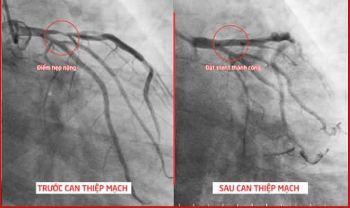 Hình ảnh trước và sau can thiệp mạch của bệnh nhân L. Ảnh BVCC