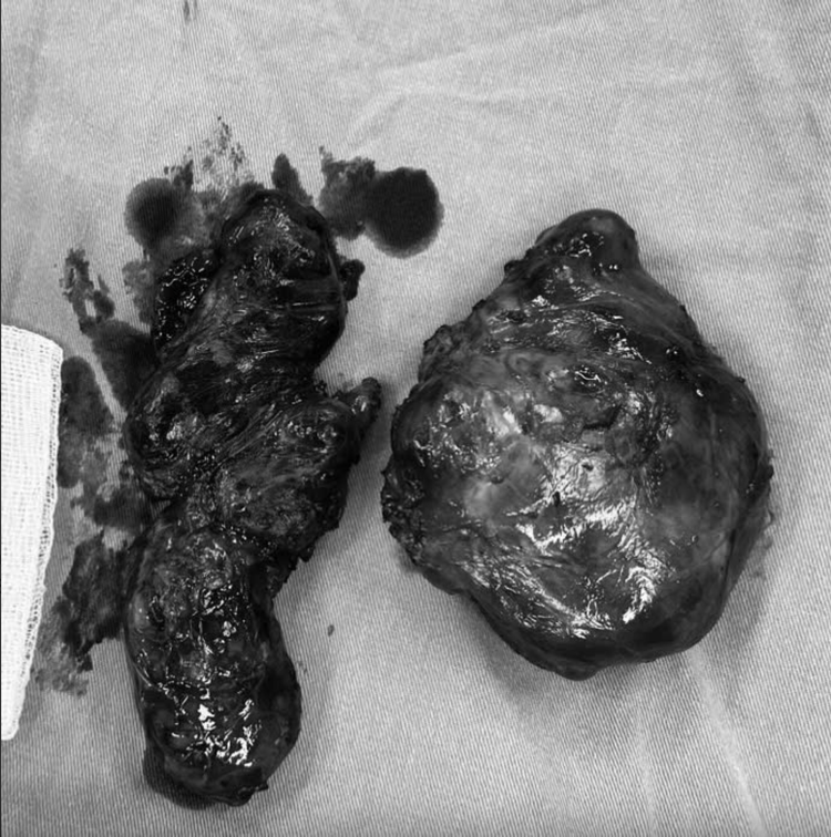 Hình ảnh khối u được lấy sau khi phẫu thuật. Ảnh: SK&ĐS Hình ảnh khối u được lấy sau khi phẫu thuật. Ảnh: SK&ĐS