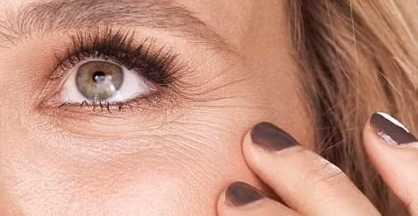 Nếp nhăn dưới mắt xảy ra khi vùng da quanh mắt mất tính đàn hồi trở nên mỏng hơn, điều này có thể tăng nhanh do tiếp xúc với ánh nắng mặt trời thường xuyên, cử động khuôn mặt lặp đi lặp lại, hút thuốc và một số đặc điểm di truyền. Ảnh Internet