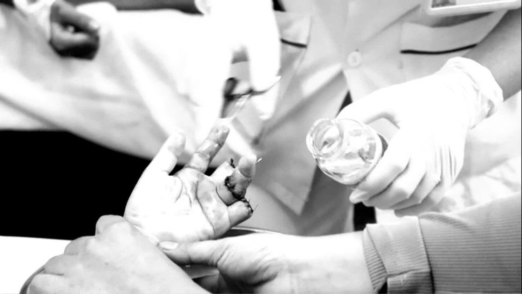Các bác sĩ đã nối thành công ngón tay số 4 cho bệnh nhi nhưng trẻ phải chịu cảnh thương tật vì mất 2 ngón. Ảnh SK&amp;ĐS