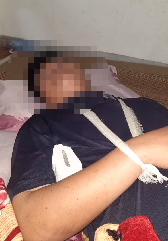 Anh D. say thuốc Lào bị ngã gãy xương đòn vai. Ảnh: Pháp luật TP HCM