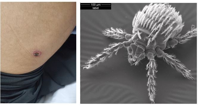 Vết bị ve mò cắn (bên trái) và bọ ve mò trên kính hiển vi (phải). Ảnh BVCC