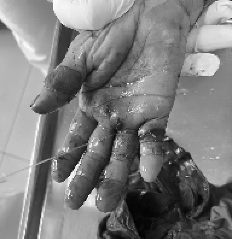 Bàn tay bị thương sau khi điện thoại phát nổ. Ảnh BVCC