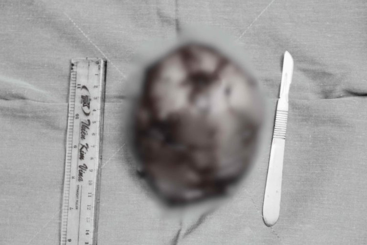 Hình ảnh khối u được bóc tách khỏi ngực bệnh nhân. Ảnh: BVCC