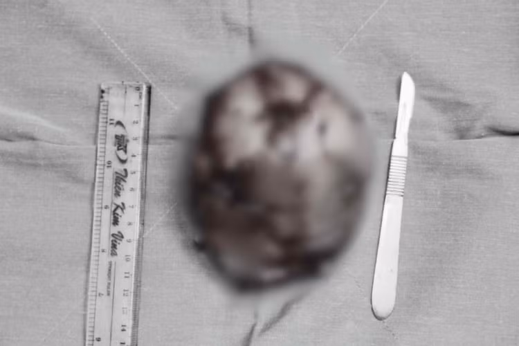 Hình ảnh khối u được bóc tách khỏi ngực bệnh nhân. Ảnh: BVCC