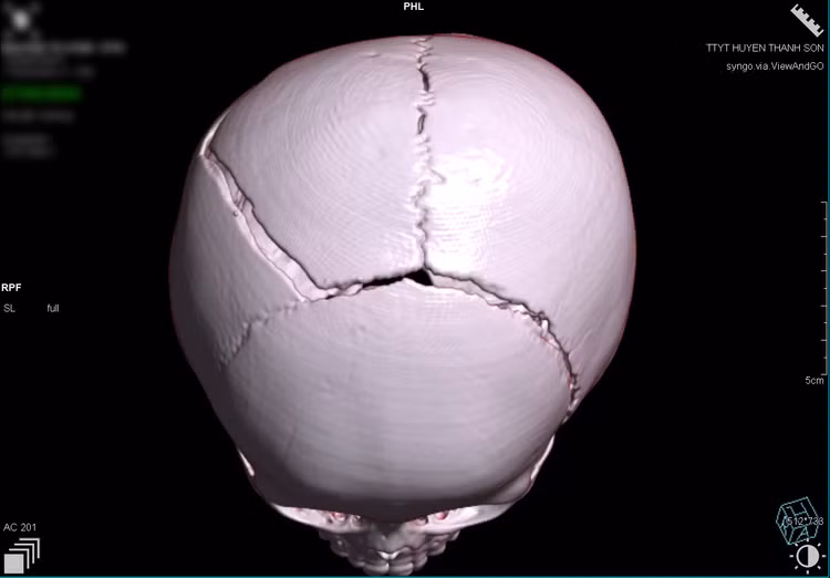 Hình ảnh phim chụp vùng đầu của bệnh nhi - Ảnh: BVCC Hình ảnh phim chụp vùng đầu của bệnh nhi - Ảnh: BVCC