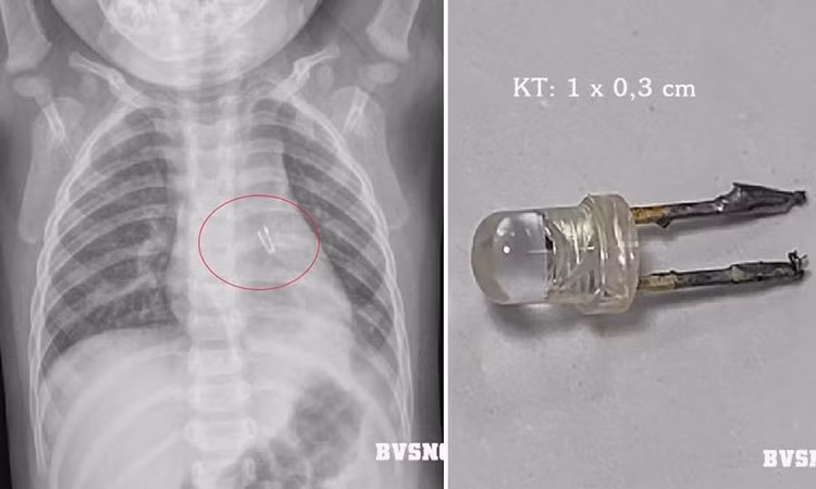 Gắp dị vật trong đường thở bé 10 tháng tuổi - Ảnh Bệnh viện Sản Nhi tỉnh Quảng Ninh