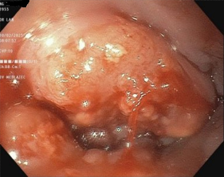 Kết quả nội soi thực quản của bệnh nhân có tổn thương u sùi loét. Ảnh minh họa