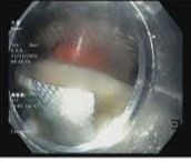 Viên thuốc còn nguyên vỉ nằm trong thực quản bệnh nhân được camera nội soi phát hiện. Ảnh BVCC