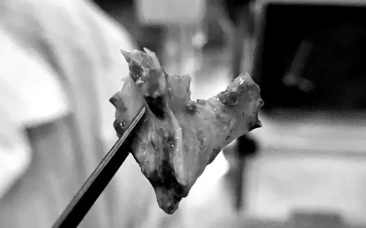 Mảnh xương được lấy ra từ mũi của bệnh nhân. Ảnh BVCC Mảnh xương được lấy ra từ mũi của bệnh nhân. Ảnh BVCC