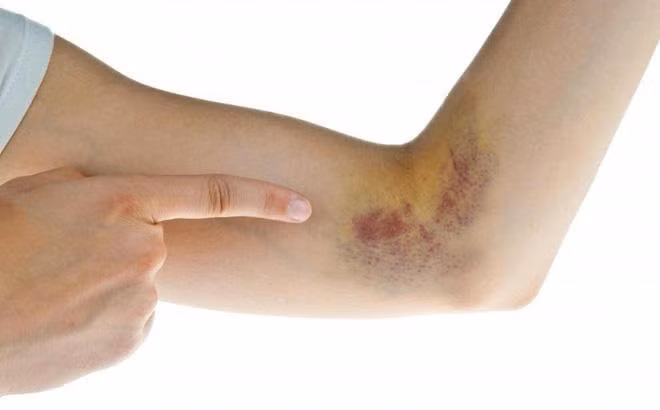 Dấu hiệu cơ thể thiếu hụt vitamin K, cần bổ sung ngay. Ảnh minh họa