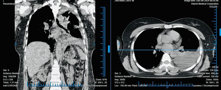 Hình ảnh phổi trước phẫu thuật. Ảnh TTYT huyện Tiên Yên (Phú Thọ)