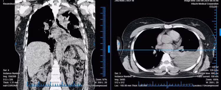 Hình ảnh phổi trước phẫu thuật. Ảnh TTYT huyện Tiên Yên (Phú Thọ)