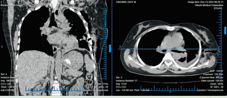 Hình ảnh phổi sau khi đã phẫu thuật. Ảnh TTYT huyện Tiên Yên (Phú Thọ)