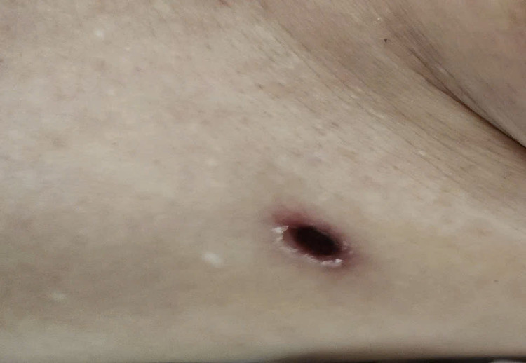 Vết loét điển hình do mò đốt. Ảnh: BVCC