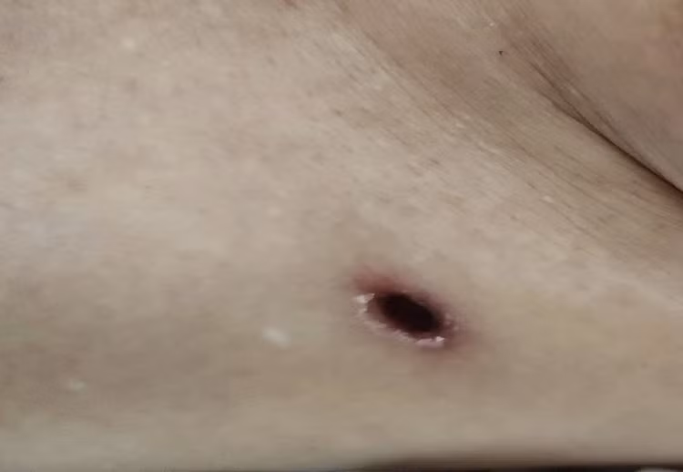 Vết loét điển hình do mò đốt. Ảnh: BVCC