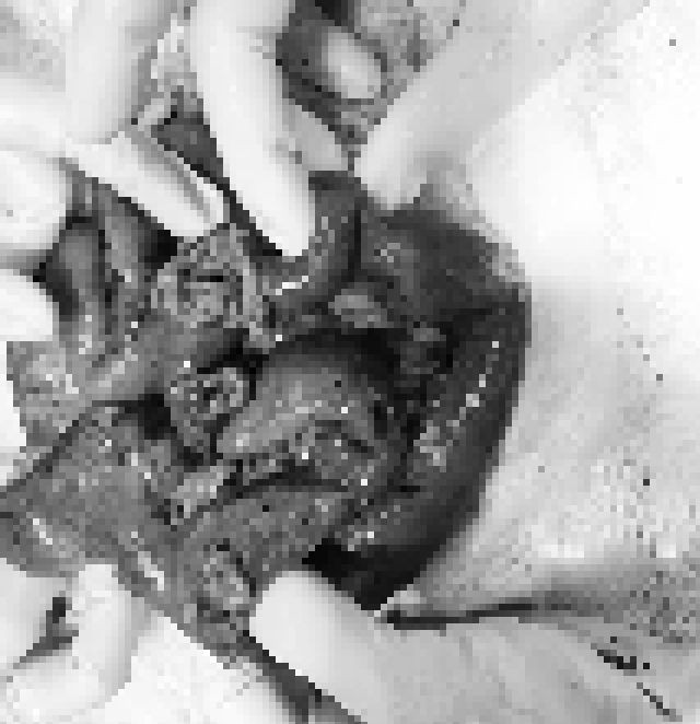 Hình ảnh ổ bụng bệnh nhân nhiều chỗ vỡ dập nát. Ảnh Sức khỏe và Đời sống Hình ảnh ổ bụng bệnh nhân nhiều chỗ vỡ dập nát. Ảnh Sức khỏe và Đời sống