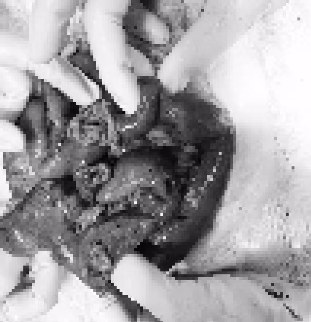 Hình ảnh ổ bụng bệnh nhân nhiều chỗ vỡ dập nát. Ảnh Sức khỏe và Đời sống Hình ảnh ổ bụng bệnh nhân nhiều chỗ vỡ dập nát. Ảnh Sức khỏe và Đời sống