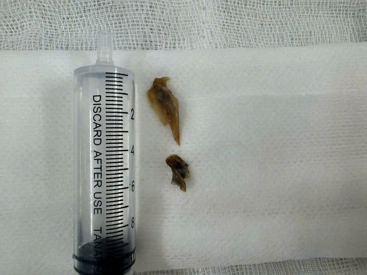 Hai mảnh xương lấy ra từ phổi bệnh nhân.