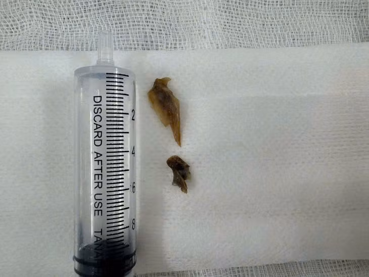 Hai mảnh xương lấy ra từ phổi bệnh nhân.