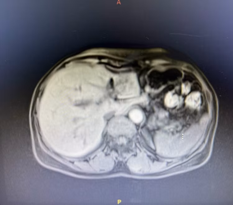 Hình ảnh CT vùng gan tổn thương của bệnh nhân. Ảnh BVCC