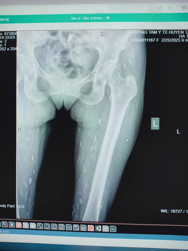 Nhiễm sán do thói quen thích ăn đồ sống. Ảnh Trung tâm Y tế huyện Tân Sơn