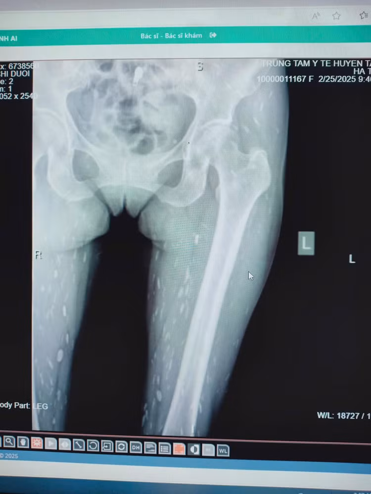 Nhiễm sán do thói quen thích ăn đồ sống. Ảnh Trung tâm Y tế huyện Tân Sơn