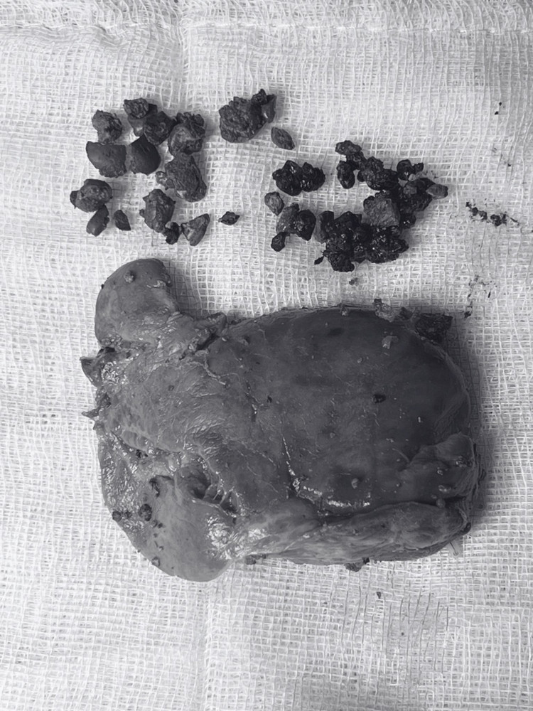 Hình ảnh sỏi và thùy gan trái được cắt bỏ của bệnh nhân. Ảnh BVCC