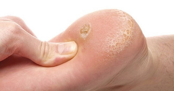 Loại bỏ các vết chai chân cứng đầu với mẹo cực đơn giản. Ảnh minh họa