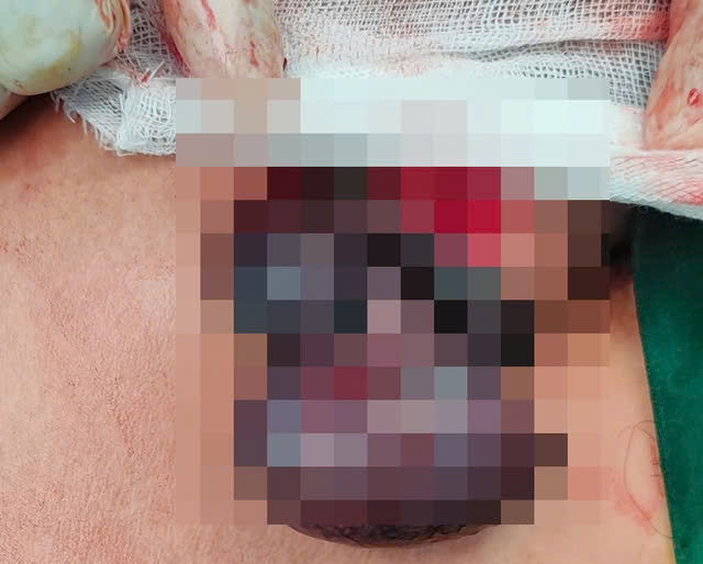 Các bác sĩ thực hiện xử lý cắt bỏ tinh hoàn phải, hạ tinh hoàn trái xuống cho nam bệnh nhân. Ảnh BVCC