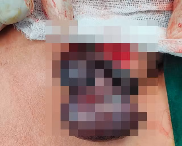 Các bác sĩ thực hiện xử lý cắt bỏ tinh hoàn phải, hạ tinh hoàn trái xuống cho nam bệnh nhân. Ảnh BVCC