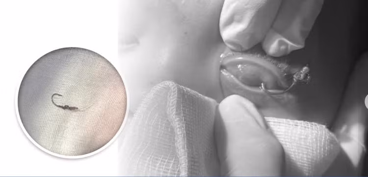 Chiếc lưỡi câu cá móc vào mắt bé trai, được các bác sĩ phẫu thuật gỡ ra. Ảnh: BVCC Chiếc lưỡi câu cá móc vào mắt bé trai, được các bác sĩ phẫu thuật gỡ ra. Ảnh: BVCC