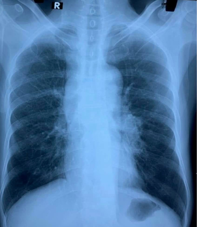 Ảnh chụp X-quang phổi người bệnh. Ảnh: BVCC.