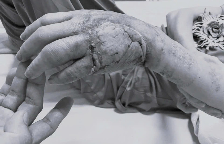 Vết thương ở bàn tay của bệnh nhân đã được ghép da và dần hồi phục