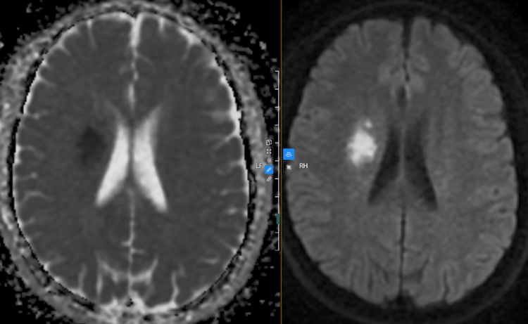 Hình ảnh chụp MRI sọ não của bệnh nhân phát hiện bất thường. Ảnh BVCC