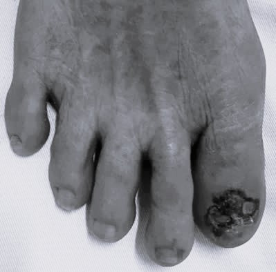 Ung thư tế bào hắc tố kẽ ngón chân. Ảnh BVCC