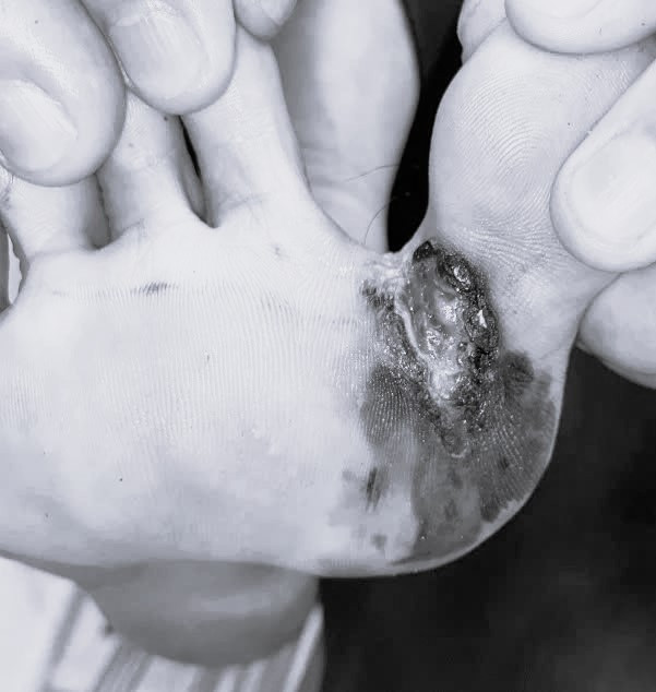 Ung thư tế bào hắc tố kẽ ngón chân. Ảnh BVCC