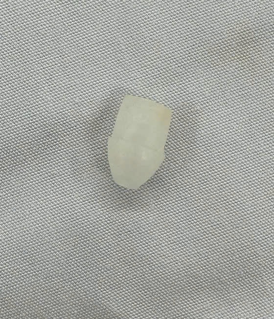 Gắp đầu bút 1cm trong đường thở của trẻ. Ảnh BVCC