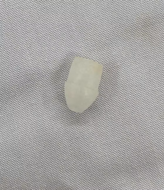 Gắp đầu bút 1cm trong đường thở của trẻ. Ảnh BVCC